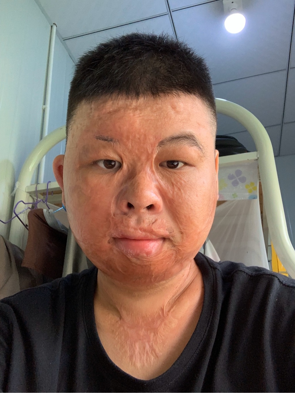 陕西省人民医院烧伤科患者正在使用医用浸浴治疗机_上海远铎医疗科技有限公司