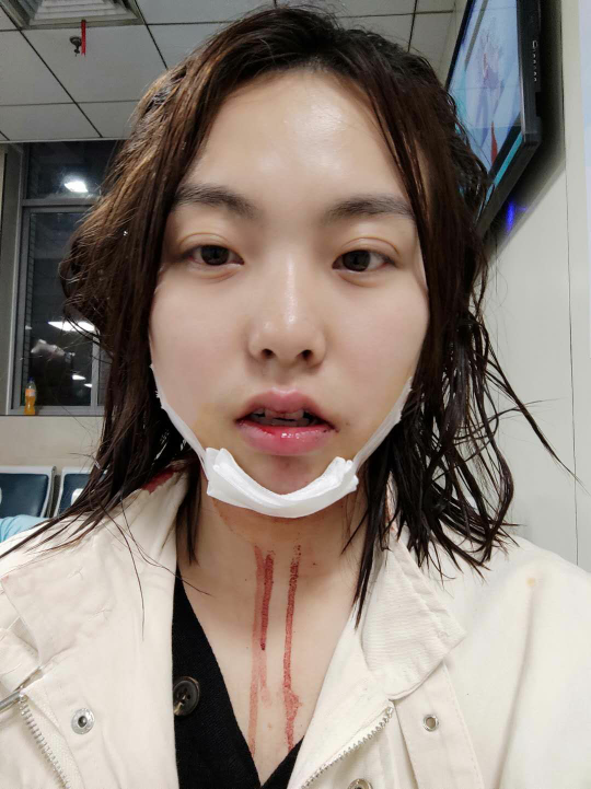 骑车摔了一跤门牙摔断了两个!下巴缝了三针!