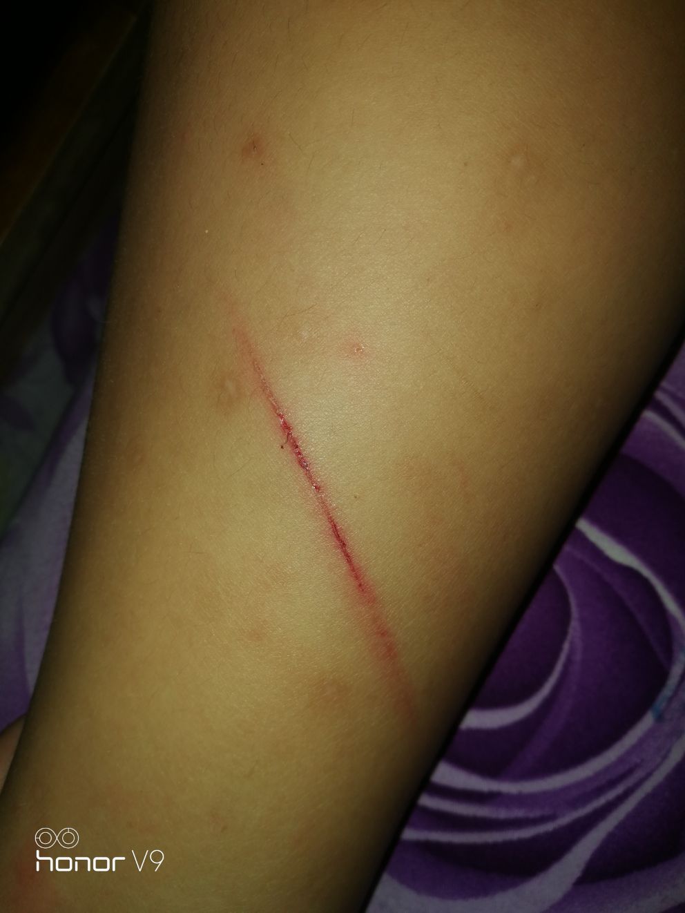 今天20点到家一推开门儿子告诉我"妈妈,我的腿被爷爷打伤了".